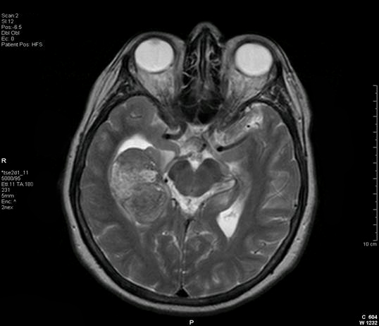 Image of axial brain tumor