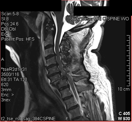 Image of traumatic spinal cord injury