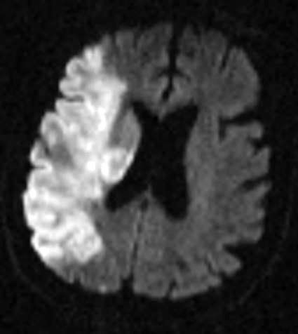 Image of hemispheric stroke