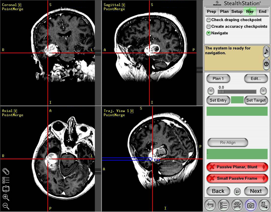 Image of stereotactic brain tumor biopsy